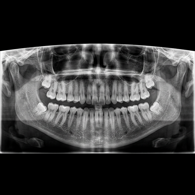 Dental Panoramic X-Ray